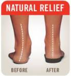 Arch Pain (Plantars Fasciitis)