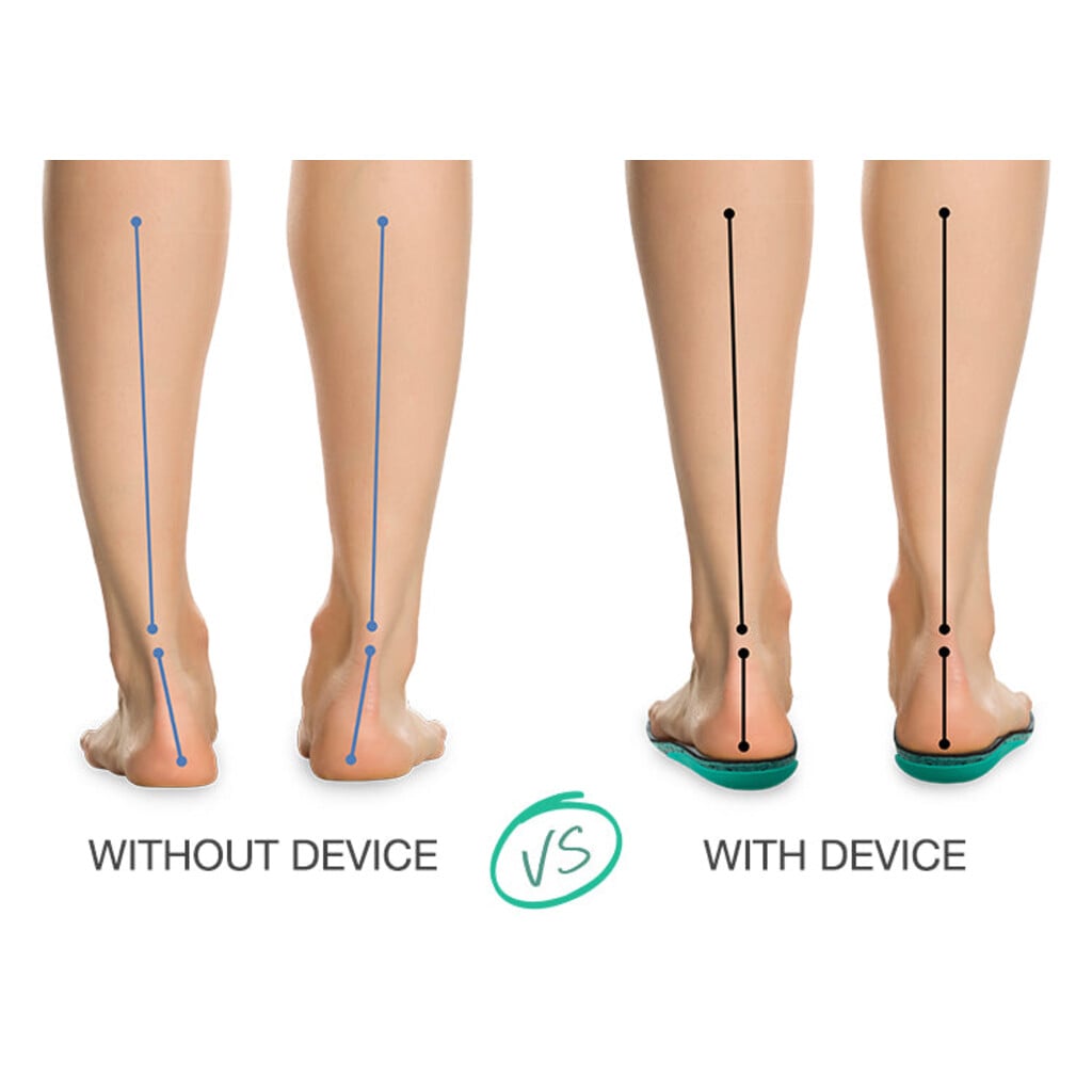 Orthofeet ANTI SUPINATION DEVICE 1 - One Color